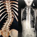 Treatment for Scoliosis is performed here
